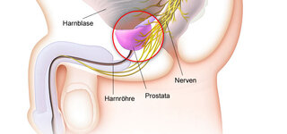 prostatitis symptome)