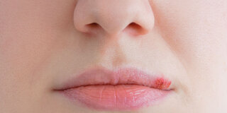 Lippenherpes: Solange die Fieberbläschen nicht verschorft sind, besteht Ansteckungsgefahr.
