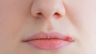 Lippenherpes: Solange die Fieberbläschen nicht verschorft sind, besteht Ansteckungsgefahr.