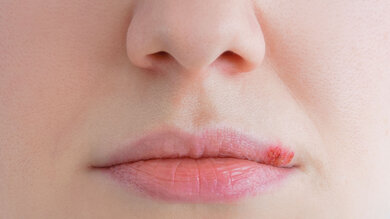 Ansteckend: Fieberbläschen an der Lippe