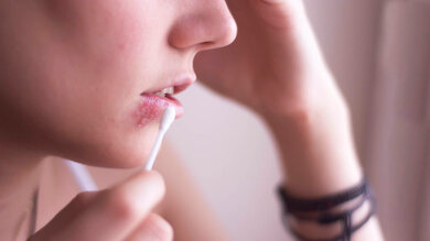 Salben gegen Lippenherpes trägt man am besten mit einem sauberen Wattestäbchen auf.