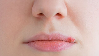 Tipps gegen Lippenbläschen 