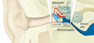 Eingriff am entzündeten Mittelohr: Ein Röhrchen zwischen Paukenhöhle und Trommelfell (Paukenröhrchen) sorgt für eine bessere Belüftung.