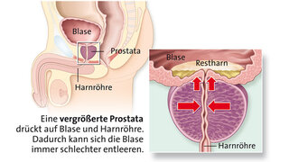 Prostata selbst tasten