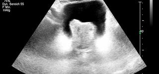 Prostatavergrößerung Ultraschallbild