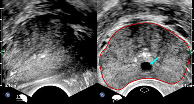 Die Prostata (rot umrandet) mit der darin verlaufenden Harnröhre (blauer Pfeil) im Ultraschallbild
