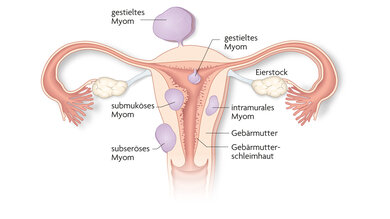 Myome können sich an verschiedenen Stellen der Gebärmutter bilden - zum Beispiel unter der Schleimhaut (submukös), in der Muskelschicht (intramural) oder an der Außenseite (subserös)