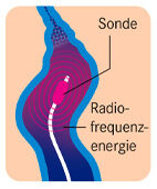 Bei der Radiowellen- oder Lasertherapie schädigt die Hitze die Gefäßwand und führt zum Geäßverschluss