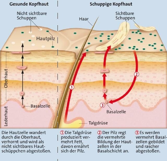 Seborrhoisches Ekzem (seborrhoische Dermatitis) ApothekenUmschau