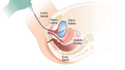 Blasenspiegelung bei der Frau: Mit dem Zystoskop kann die Ärztin oder der Arzt Harnröhre und Blase von innen betrachten und untersuchen.