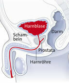 Bei Männern liegt die Prostata unter der Harnblase. Ist sie deutlich vergrößert, kann der Arzt das indirekt an einer Verengung der Harnröhre erkennen
