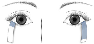Schirmer Test (Augenflüssigkeitsmessung)