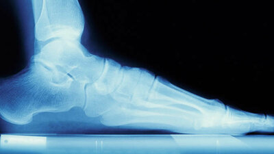 Röntgenaufnahme vom Fuß