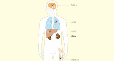Nierenzellkrebs bildet vor allem in Leber, Lunge, Knochen und Gehirn Metastasen