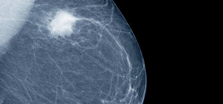Mammographie einer Brust mit Knoten