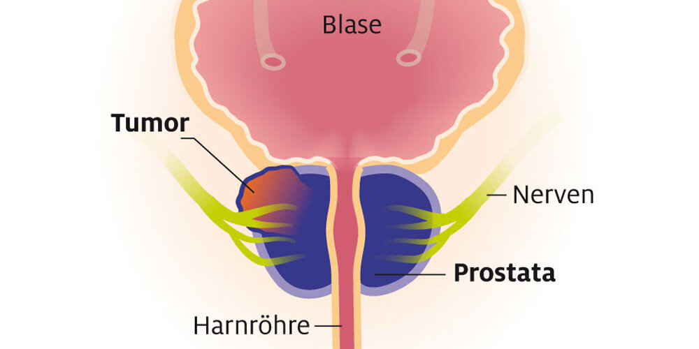 prostata tumor entfernen)