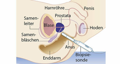 Die Biopsie der Prostata erfolgt über den Enddarm