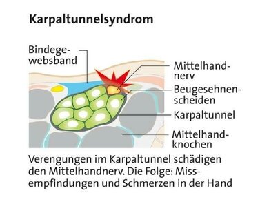 Querschnitt durch das Handgelenk: Beim Karpaltunnelsyndrom wird es dem Medianus-Nerv im Karpalkanal zu eng
