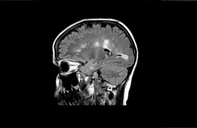 MRT-Bild eines Gehirns mit MS: Die hellgrauen Flecken sind Entzündungsherde
