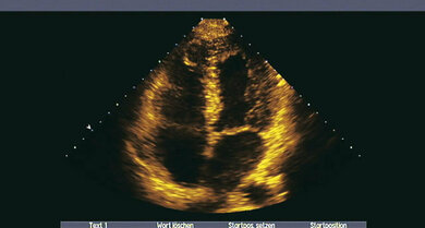 Ultraschallbild des Herzens