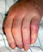 Gichtanfall: Das Fingergelenk ist rot und geschwollen