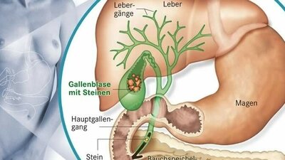 Gallensteine in Gallengang und Gallenblase