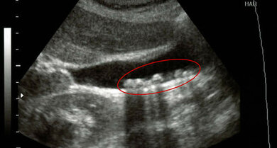 Gallensteine (rot eingekreist) im Ultraschallbild