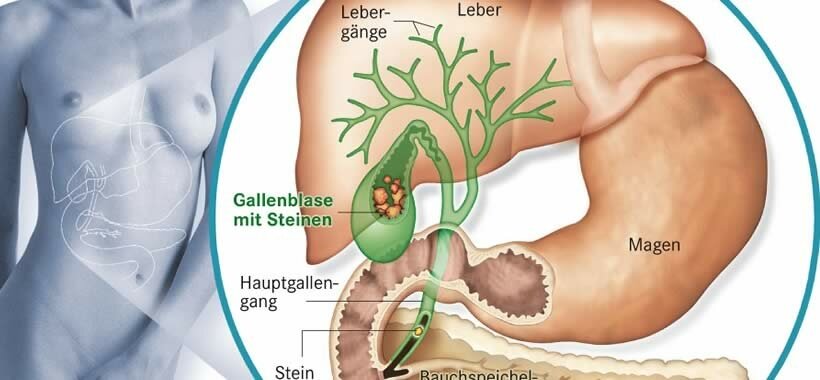 Gallenbeschwerden bauchschmerzen Gallenbeschwerden