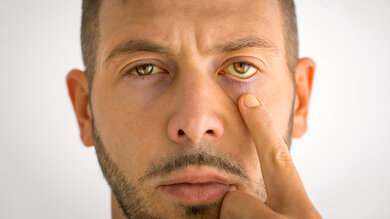Gelbe Augen: Ein Ikterus kann auf eine Entzündung der Leber hinweisen.
