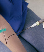 Blutentnahme: Oft geben erhöhte Leberwerte den ersten Hinweis auf eine Hepatitis