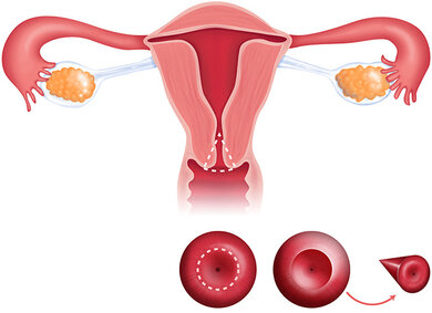 Konisation: Ein kegelförmiger Teil des Muttermunds wird entfernt