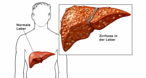 Leberkrebs (Leberzellkrebs, Leberzellkarzinom, Hepatozelluläres