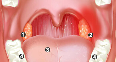 So kann sich eine Mandelentzündung zeigen: Die Gaumenmandeln (1, 2) sind gerötet, geschwollen und mit Eiterflecken belegt (3 = Zunge, 4 = Zähne)
