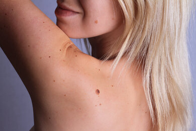 Sind mehr als 50 Leberflecken vorhanden, ist das Hautkrebsrisiko etwas erhöht