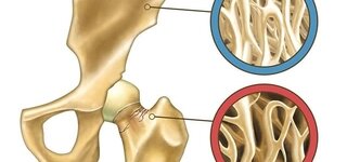 Illustration zeigt normalen Knochen und Osteoporose