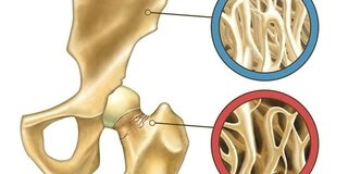 Illustration zeigt normalen Knochen und Osteoporose