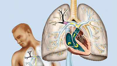 Darstellung, Lungenembolie und Bein-Thrombose