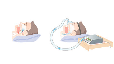 Links: Zunge und Muskeln verlegen die Atemwege (roter Kreis). Rechts: Die Atemmaske erzeugt einen leichten Überdruck, der die Atemwege offen hält, so dass die Atemluft wieder ungehindert strömen kann (blaue Pfeile).