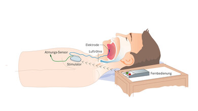 Bei Schlafapnoe kann manchmal ein Zungenschrittmacher helfen. Es gibt verschiedene Modelle. Ein kleines Gerät wird unter der Haut eingesetzt. Es stimuliert den Zungen-Nerv.