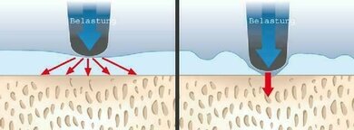 Ein gesunder Knorpel (links) verteilt den Druck; ein infolge Arthrose beschädigter (rechts) kann das nicht mehr