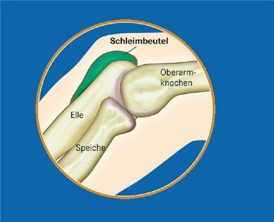 Schleimbeutel im Ellbogen (bursa olecrani): Dient der Verschieblichkeit der Haut über dem Knochen