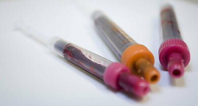 Bluttests: Oft hilfreich für die Diagnose