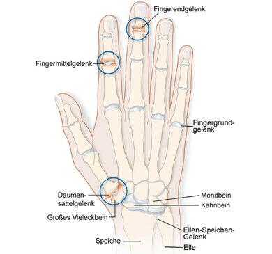 Fingerendgelenke, Fingermittelgelenke und das Daumensattelgelenk (mit Kreisen markiert) sind bei einer Polyarthrose häufig betroffen.