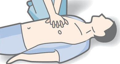 Atmet ein Fiebernder nicht, sofort zur Herzdruckmassage übergehen: Zweimal pro Sekunde den Brustkorb zusammenpressen