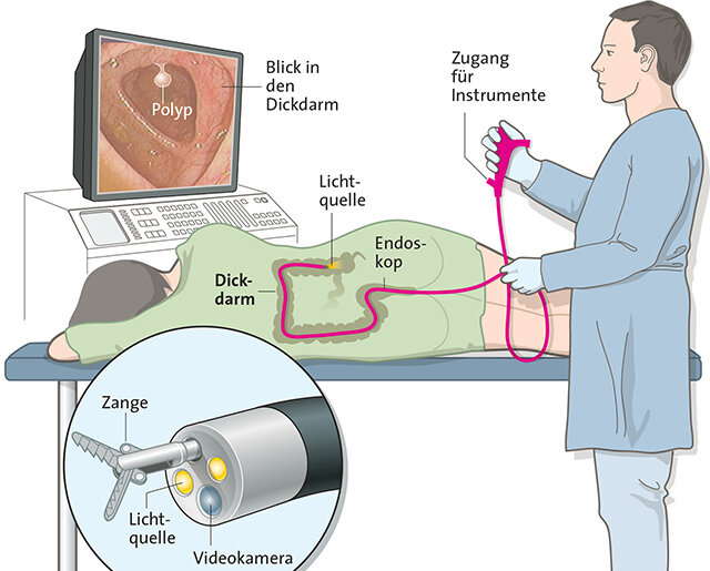 Blut am After / aus dem Darm Ursachen im Enddarm, Dickdarm Dünndarm ApothekenUmschau