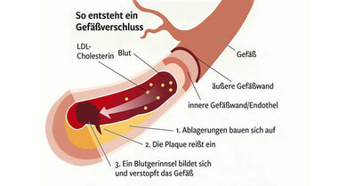 Gefäßverkalkung (Arteriosklerose) gefährdet die Durchblutung