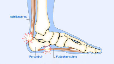 Fersenschmerzen, hier symbolisiert durch Sterne, betreffen oft die Achillessehne oder die Fußsohlensehne.