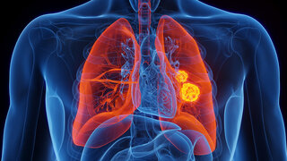 Anatomische Illustration einer Lunge mit Tumoren im linken Lungenflügel