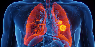 Anatomische Illustration einer Lunge mit Tumoren im linken Lungenflügel