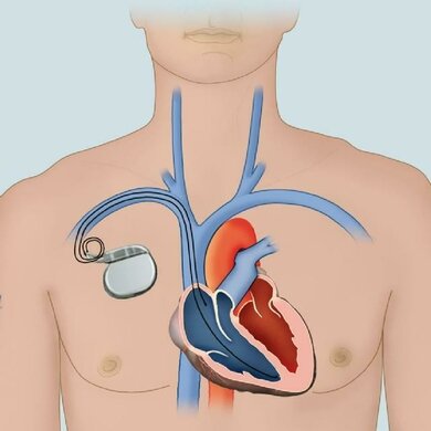 Der dauerhafte Herzschrittmacher wird unter der Haut in den Körper eingebaut und über Kabel in den Venen mit dem Herz verbunden